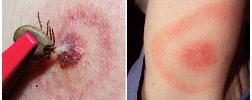 Co je Lyme nemoc, její příznaky, léčba a fotografie